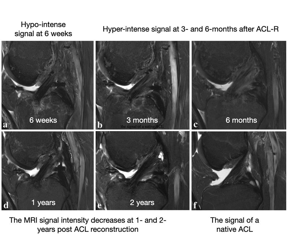 KSSTA's tweet photo. This present study of Lutz et al. shows #MRI #ACL #graft maturation and its' correlation with #returntosports, #clinicaloutcomescore, and #kneelaxity at 1 and 2 years postoperatively.
#ACLrehab #ACLreconstruction
Link: https://t.co/SxCseqTpqb https://t.co/DtUdVmjBAd