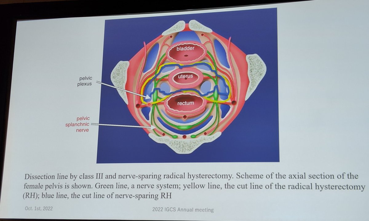 JayrajAarthi's tweet photo. A step-by-step ecture on nerve sparing radical hysterectomy by Dr Tomoyasu Kato #IGCS2020 https://t.co/jDCLZfPgg5