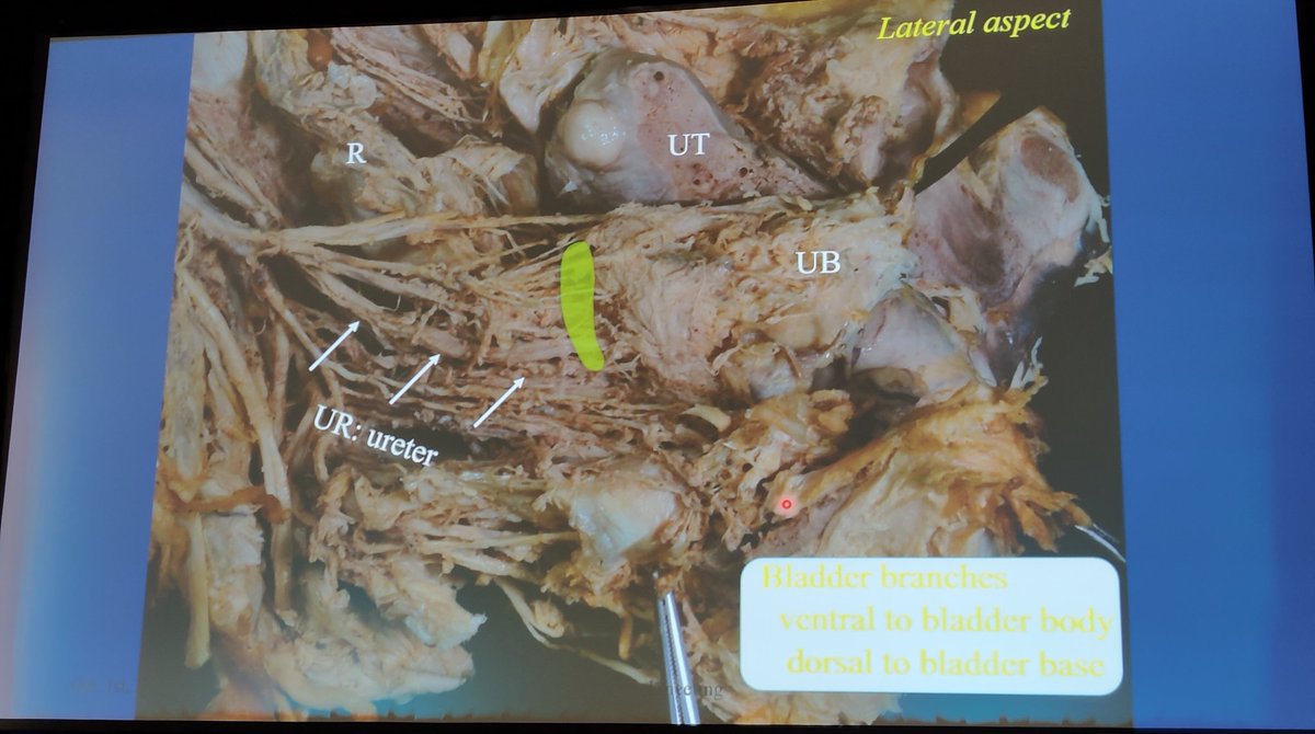 JayrajAarthi's tweet photo. A step-by-step ecture on nerve sparing radical hysterectomy by Dr Tomoyasu Kato #IGCS2020 https://t.co/jDCLZfPgg5