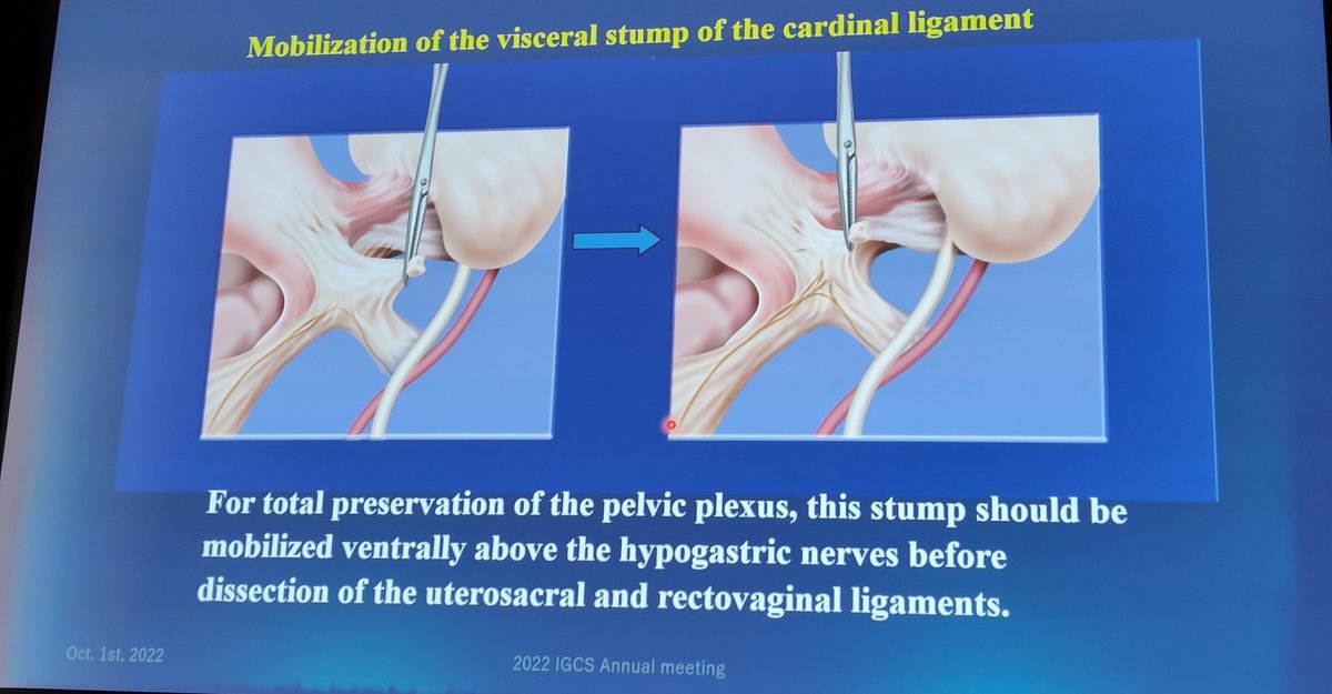 JayrajAarthi's tweet photo. A step-by-step ecture on nerve sparing radical hysterectomy by Dr Tomoyasu Kato #IGCS2020 https://t.co/jDCLZfPgg5