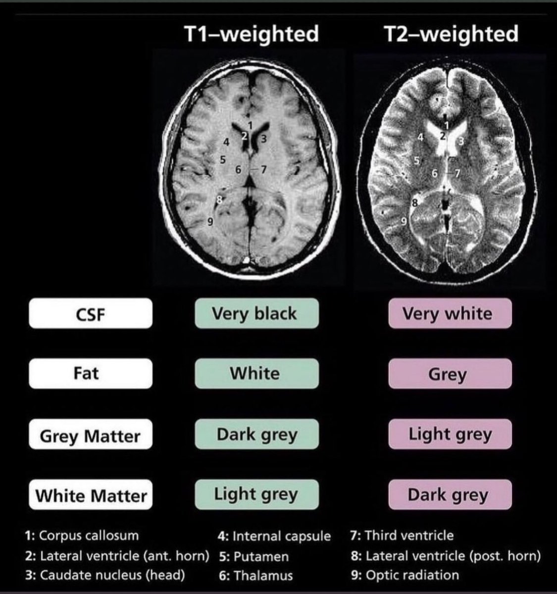 imedverse's tweet photo. T1 weighted vs T2 weighted MRI

@DrPharmDMDTh @imedverse 

#TipsForNewDocs #MedEd #MedTwitter #medicine #medical #medicare #health #healthcare #FOAMed #ClinicalPearl #clinicaltips #MedStudents #neuroradiology #Radiology #neurotwitter https://t.co/d6F9l6ZIcE