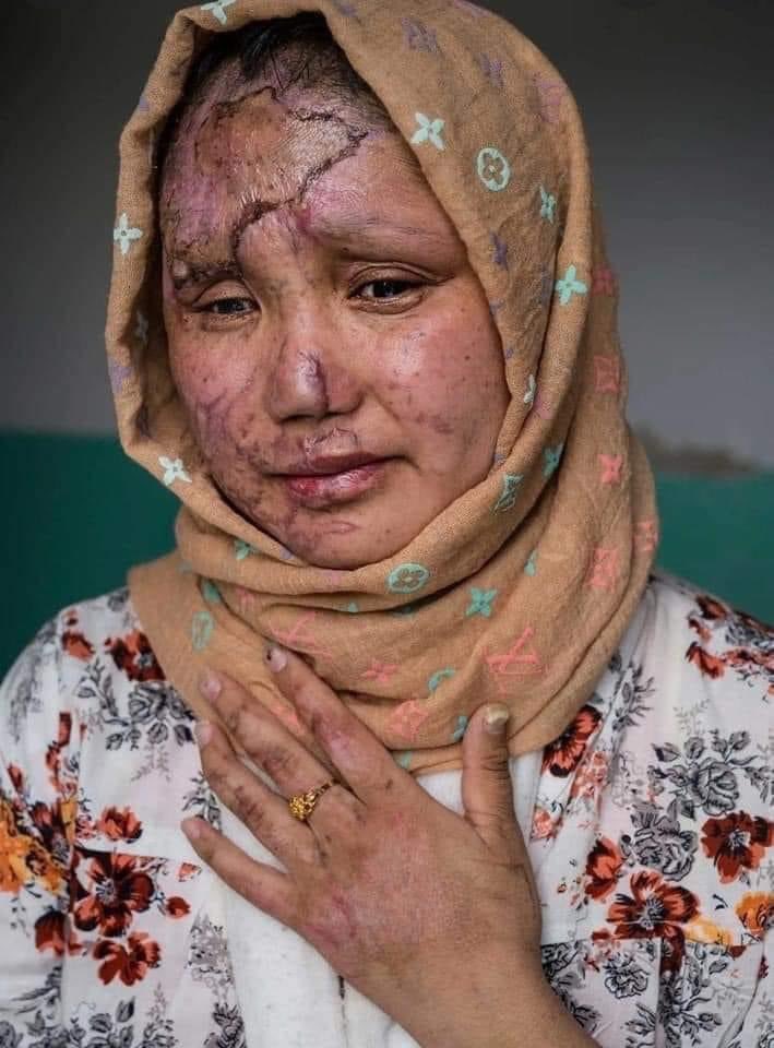 The face of a survivor of the recent bombing at a university in Kabul. The #KABULBLAST resulted in deaths of innocents Hazara community girls. 

We don't know how long we will witness such tragedies & planned #ShiaGenocide but let me assure the enemies; we won't fear you! Never!