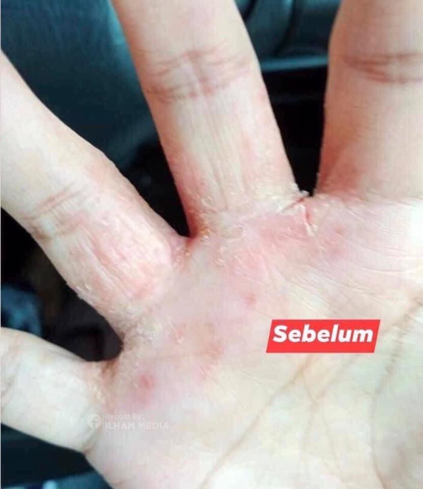 officialfans95's tweet photo. Tak sangka pakai krim vaseline ni hilang alergik kat celah celah jari ni.. Ya Allah azab sangat tau, kene air pun sakit.. Nak basuh pinggan pun susah.. Korang cuba lah mana tahu serasi..
.
Harga pun tak sampai rm10: https://t.co/hDIqvO11B3 https://t.co/MSMxvZhrZb