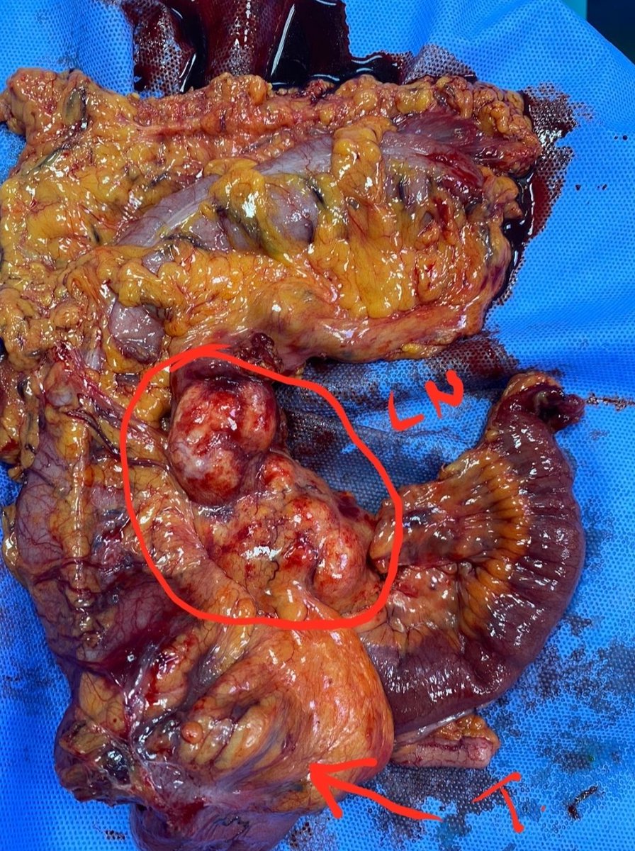 uraiqat's tweet photo. 57 years old female with advanced cecal tumor with large mesenteric LN.Had laparoscopic ext. Rt colectomy with CME. https://t.co/kFKpAA9SRm