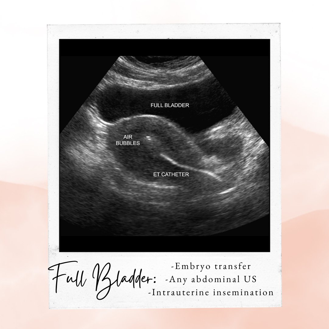ErikaNewMD's tweet photo. The mystery solved of when to have a full or empty bladder for a GYN ultrasound 🤔

Full bladder for:
➡️Embryo transfer
➡️Any abdominal US
➡️IUI

Empty bladder for:
➡️Egg retrieval
➡️Saline infusion US
➡️Any transvaginal US

#ultrasound #infertility #IVF  #obgyn #eggretrieval https://t.co/NIk5IhB4Yw