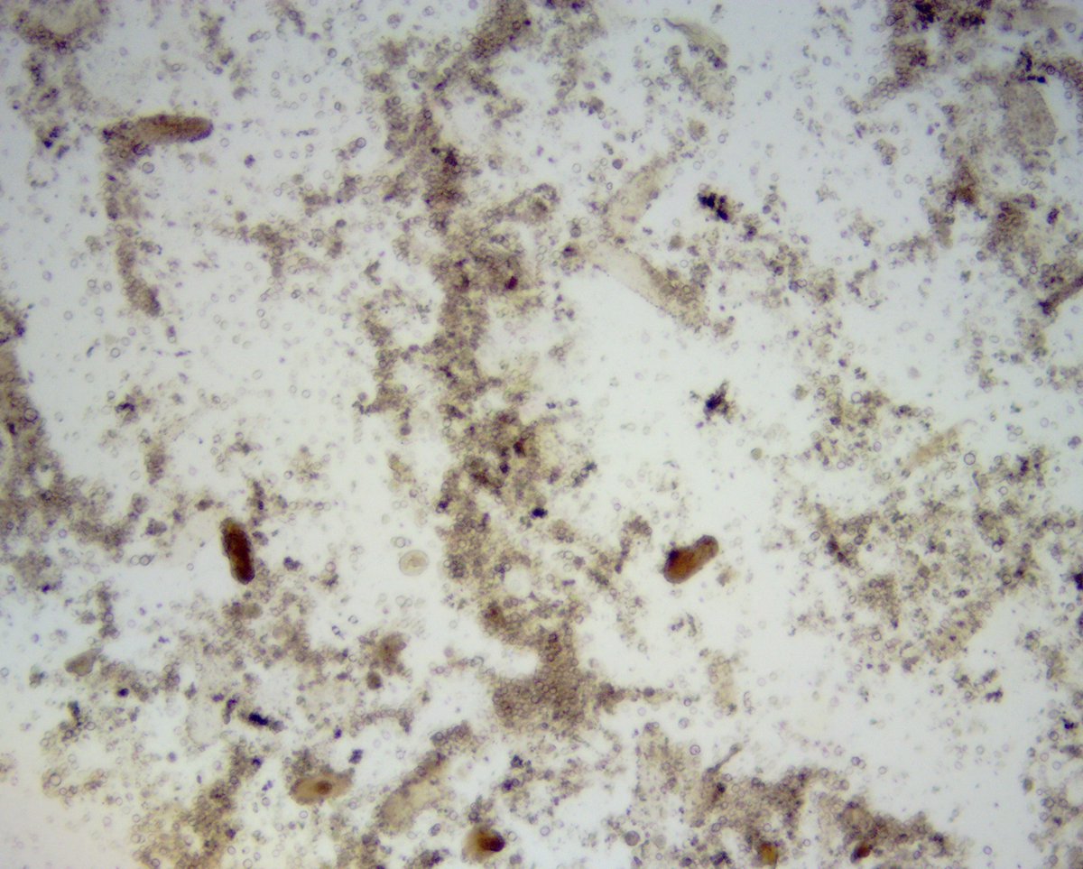 VelezNephHepato's tweet photo. Lightly granular cast w/embedded leucine crystal, other granular casts, BP 138/88, AKI, acute portal hypertension, but overall picture not c/w HRS #UrinarySediment #UrineMicroscopy pt of @OchsnerNephro fellow @PJMartinezPitre #WeekendCall https://t.co/DjwAAmgniC