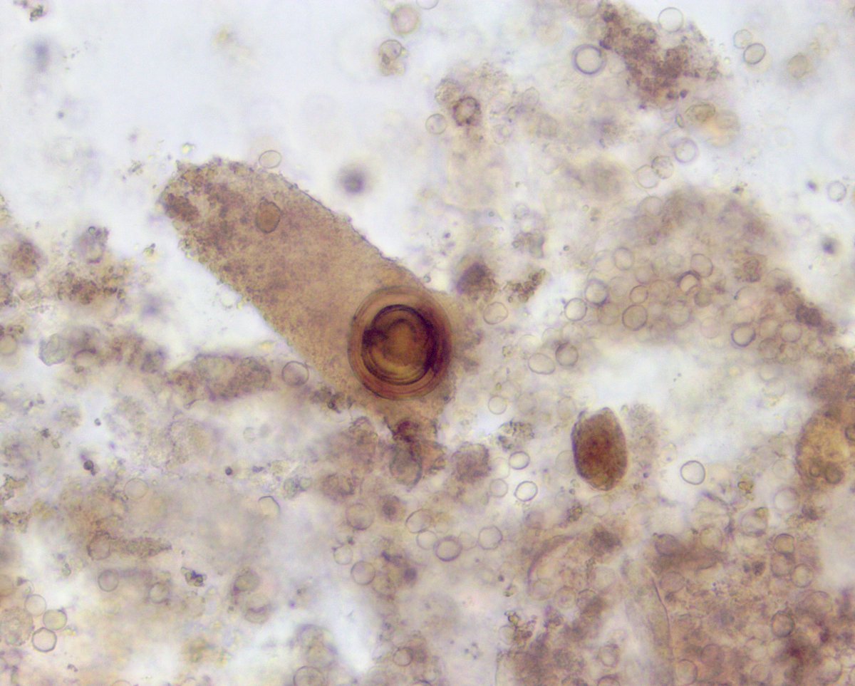 VelezNephHepato's tweet photo. Lightly granular cast w/embedded leucine crystal, other granular casts, BP 138/88, AKI, acute portal hypertension, but overall picture not c/w HRS #UrinarySediment #UrineMicroscopy pt of @OchsnerNephro fellow @PJMartinezPitre #WeekendCall https://t.co/DjwAAmgniC