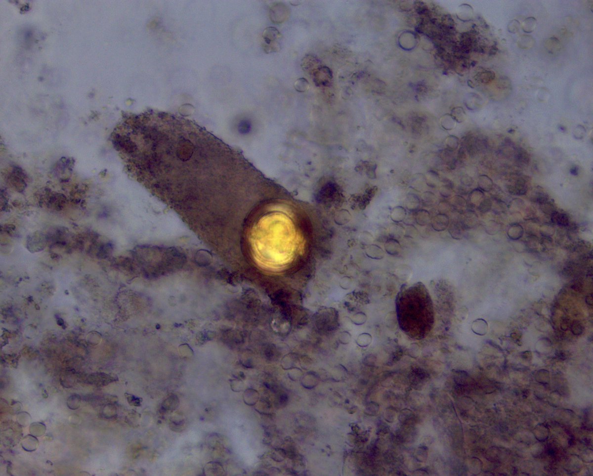 VelezNephHepato's tweet photo. Lightly granular cast w/embedded leucine crystal, other granular casts, BP 138/88, AKI, acute portal hypertension, but overall picture not c/w HRS #UrinarySediment #UrineMicroscopy pt of @OchsnerNephro fellow @PJMartinezPitre #WeekendCall https://t.co/DjwAAmgniC
