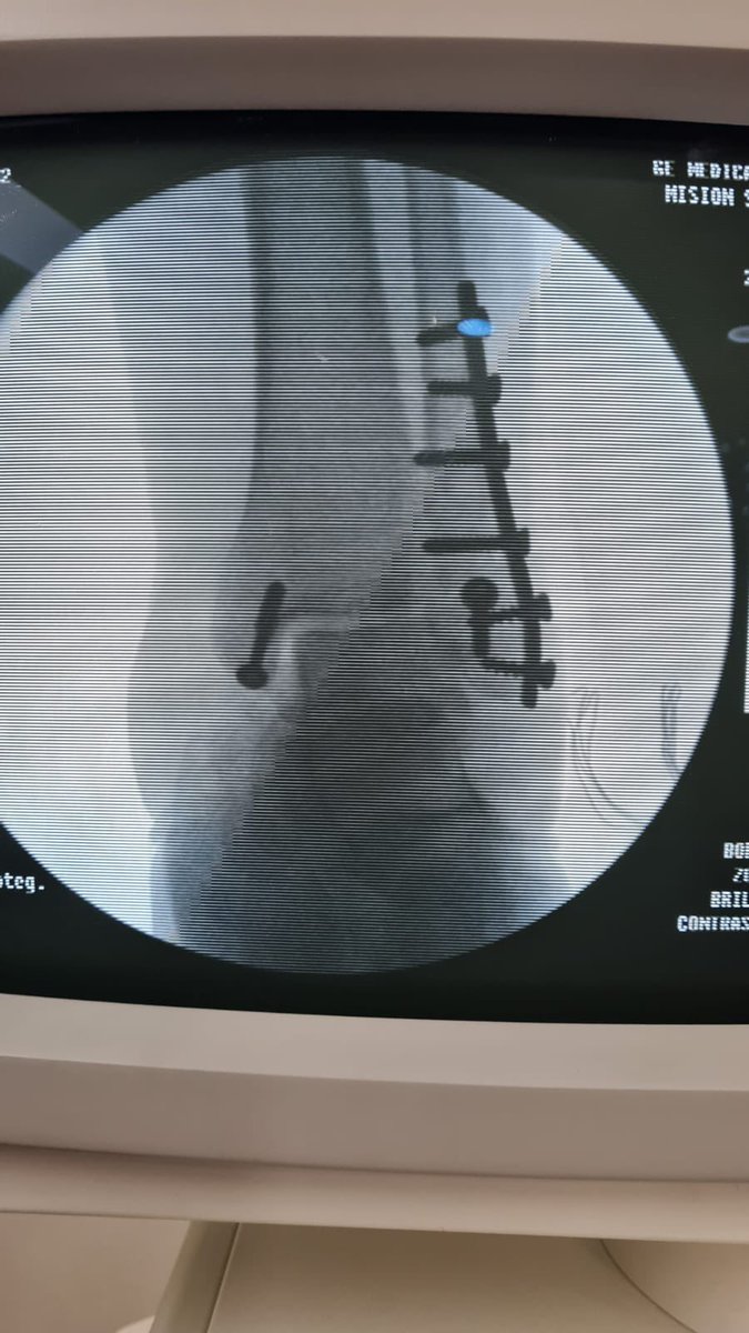 ortopediaabm's tweet photo. Osteosintesis exitosa de Fractura Luxación tibia y peroné bimaleolar de tobillo control trasnsoperatorio #OrtopediaABM #FracturaTobillo #TraumatologoTlajomulco #OrtopedistaTlajomulco #OrtopedistaPuertaHierroSur #TraumatologoPuertaHierroSur #FracturaTobillo #OsteosintesisTobillo https://t.co/Iym15lHNRr