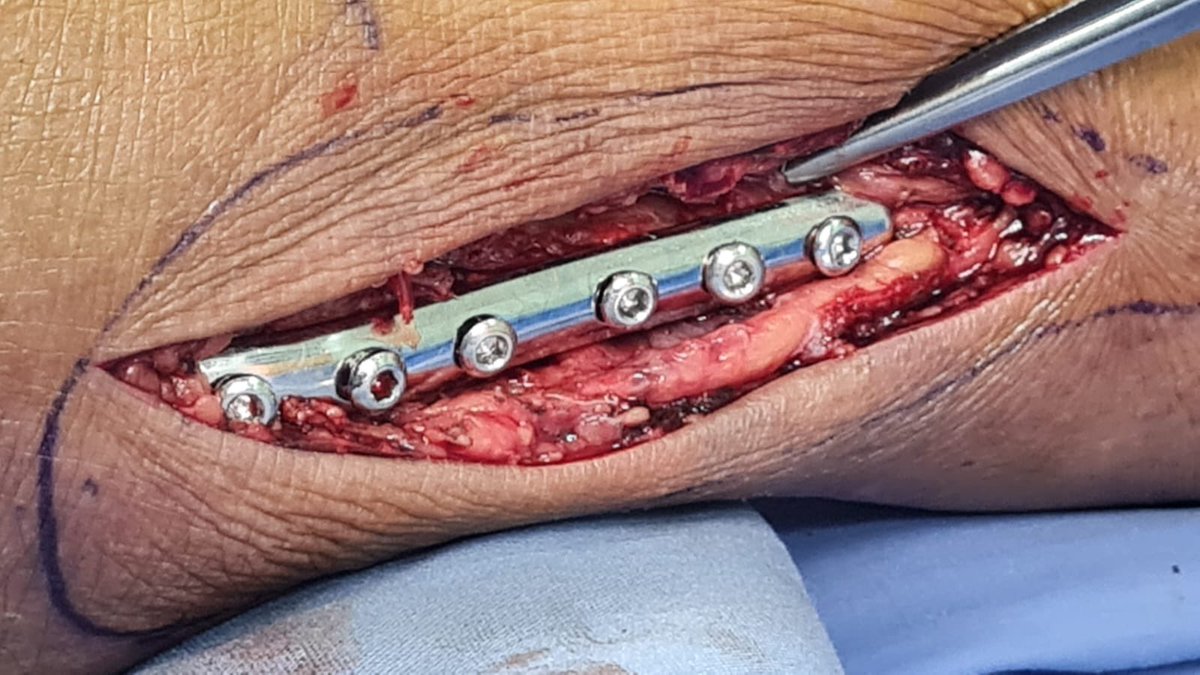 ortopediaabm's tweet photo. Osteosintesis exitosa de Fractura Luxación tibia y peroné bimaleolar de tobillo control trasnsoperatorio #OrtopediaABM #FracturaTobillo #TraumatologoTlajomulco #OrtopedistaTlajomulco #OrtopedistaPuertaHierroSur #TraumatologoPuertaHierroSur #FracturaTobillo #OsteosintesisTobillo https://t.co/Iym15lHNRr