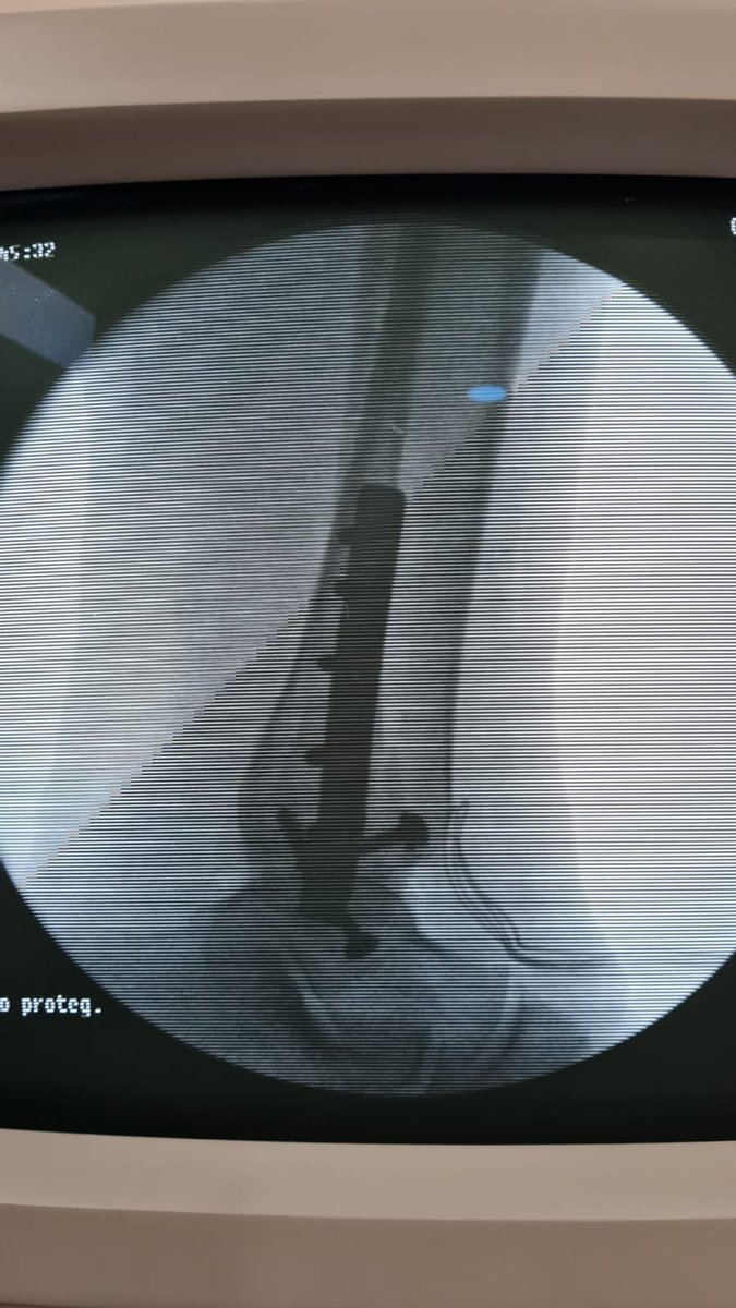 ortopediaabm's tweet photo. Osteosintesis exitosa de Fractura Luxación tibia y peroné bimaleolar de tobillo control trasnsoperatorio #OrtopediaABM #FracturaTobillo #TraumatologoTlajomulco #OrtopedistaTlajomulco #OrtopedistaPuertaHierroSur #TraumatologoPuertaHierroSur #FracturaTobillo #OsteosintesisTobillo https://t.co/Iym15lHNRr
