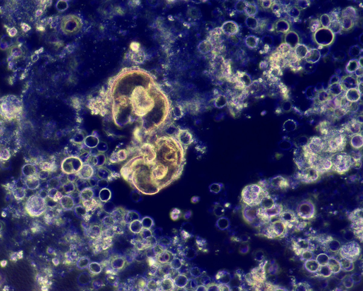 VelezNephHepato's tweet photo. “Mushroom-like” leucine crystals and isomorphic RBCs, waxy cast indicative of tubular injury. AKI, suspected congestive hepatopathy #UrineMicroscopy #UrinarySediment pt of @OchsnerNephro fellow @PJMartinezPitre #WeekendCall https://t.co/D8s4WKZ0iR
