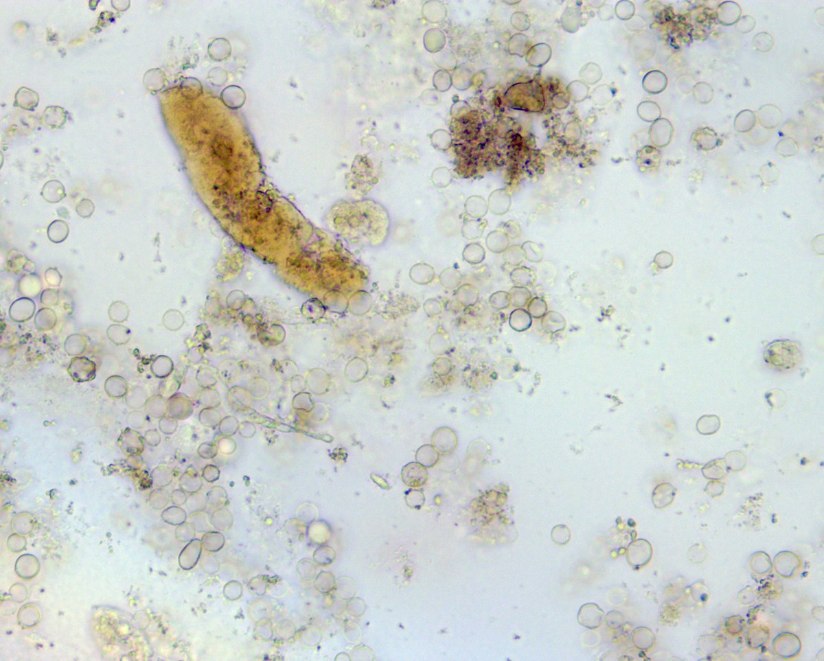 VelezNephHepato's tweet photo. “Mushroom-like” leucine crystals and isomorphic RBCs, waxy cast indicative of tubular injury. AKI, suspected congestive hepatopathy #UrineMicroscopy #UrinarySediment pt of @OchsnerNephro fellow @PJMartinezPitre #WeekendCall https://t.co/D8s4WKZ0iR