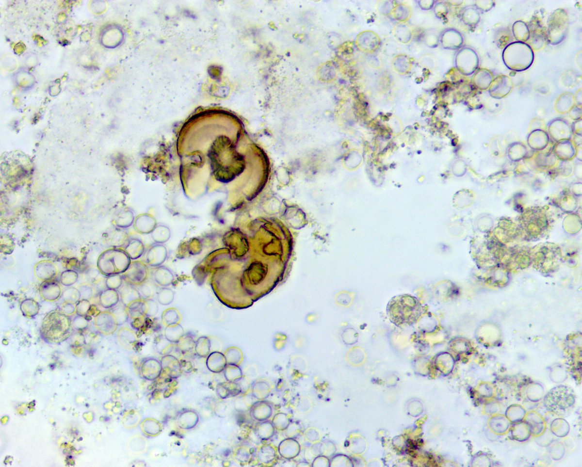 VelezNephHepato's tweet photo. “Mushroom-like” leucine crystals and isomorphic RBCs, waxy cast indicative of tubular injury. AKI, suspected congestive hepatopathy #UrineMicroscopy #UrinarySediment pt of @OchsnerNephro fellow @PJMartinezPitre #WeekendCall https://t.co/D8s4WKZ0iR