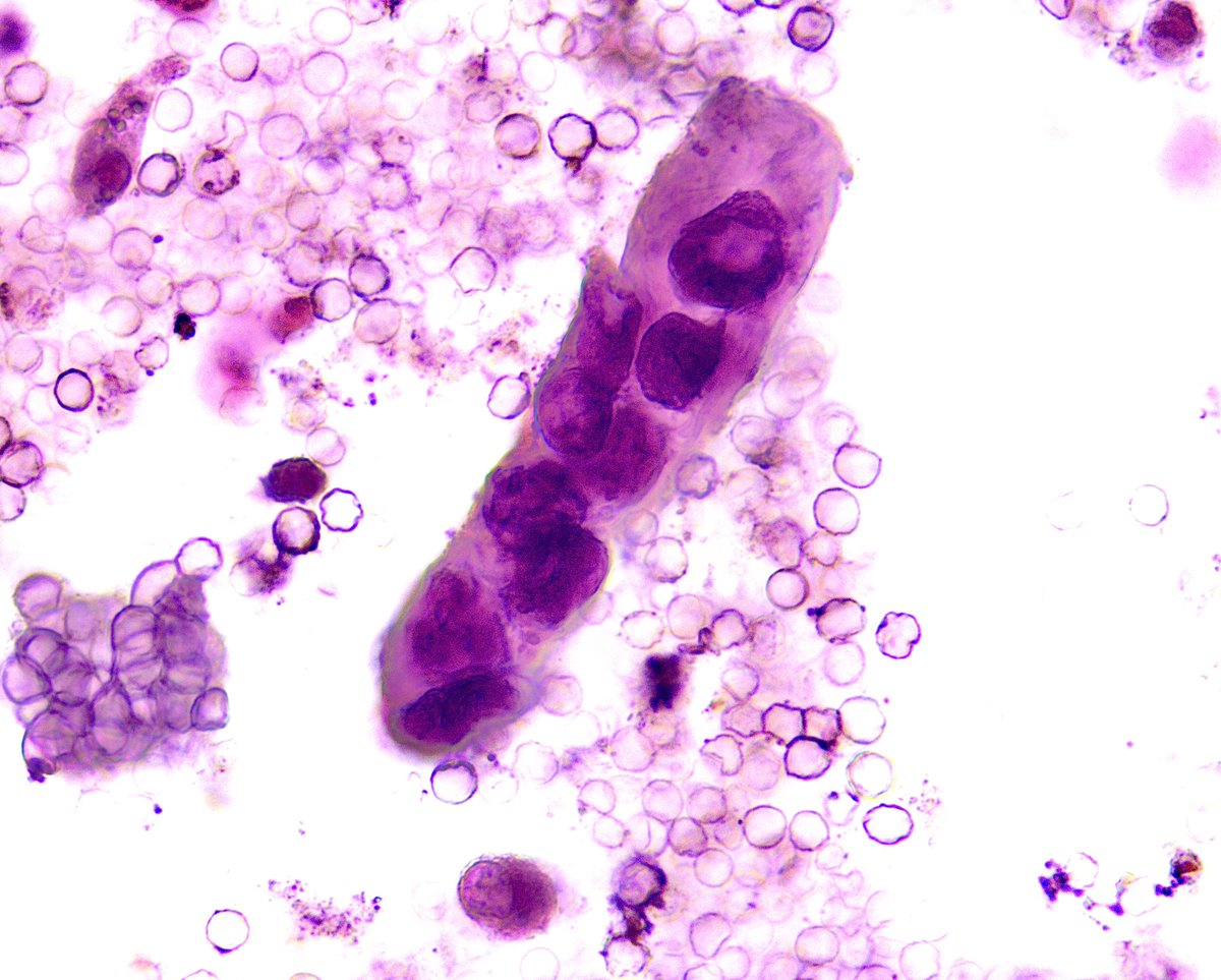 VelezNephHepato's tweet photo. Mixed (hyaline/granular) cast w/embedded CaOx monohydrate crystal, RTEC cast, isomorphic RBCs. U Na 38. AKI, ESLD, ATN, not HRS #UrinarySediment #UrineMicroscopy pt of @IMresOchsner resident @dani_nephron #WeekendCall https://t.co/ILI8AoUPgv