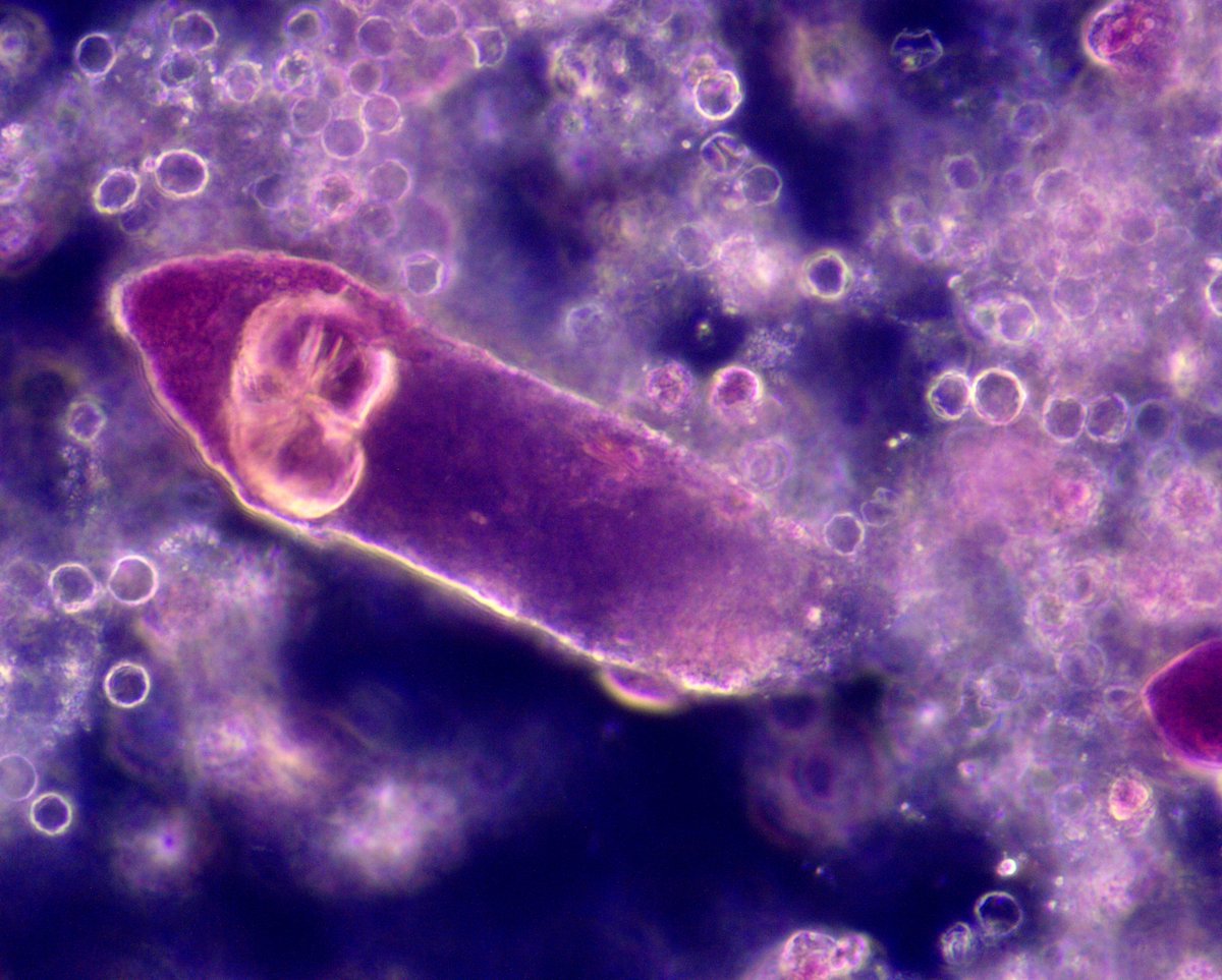 VelezNephHepato's tweet photo. Mixed (hyaline/granular) cast w/embedded CaOx monohydrate crystal, RTEC cast, isomorphic RBCs. U Na 38. AKI, ESLD, ATN, not HRS #UrinarySediment #UrineMicroscopy pt of @IMresOchsner resident @dani_nephron #WeekendCall https://t.co/ILI8AoUPgv