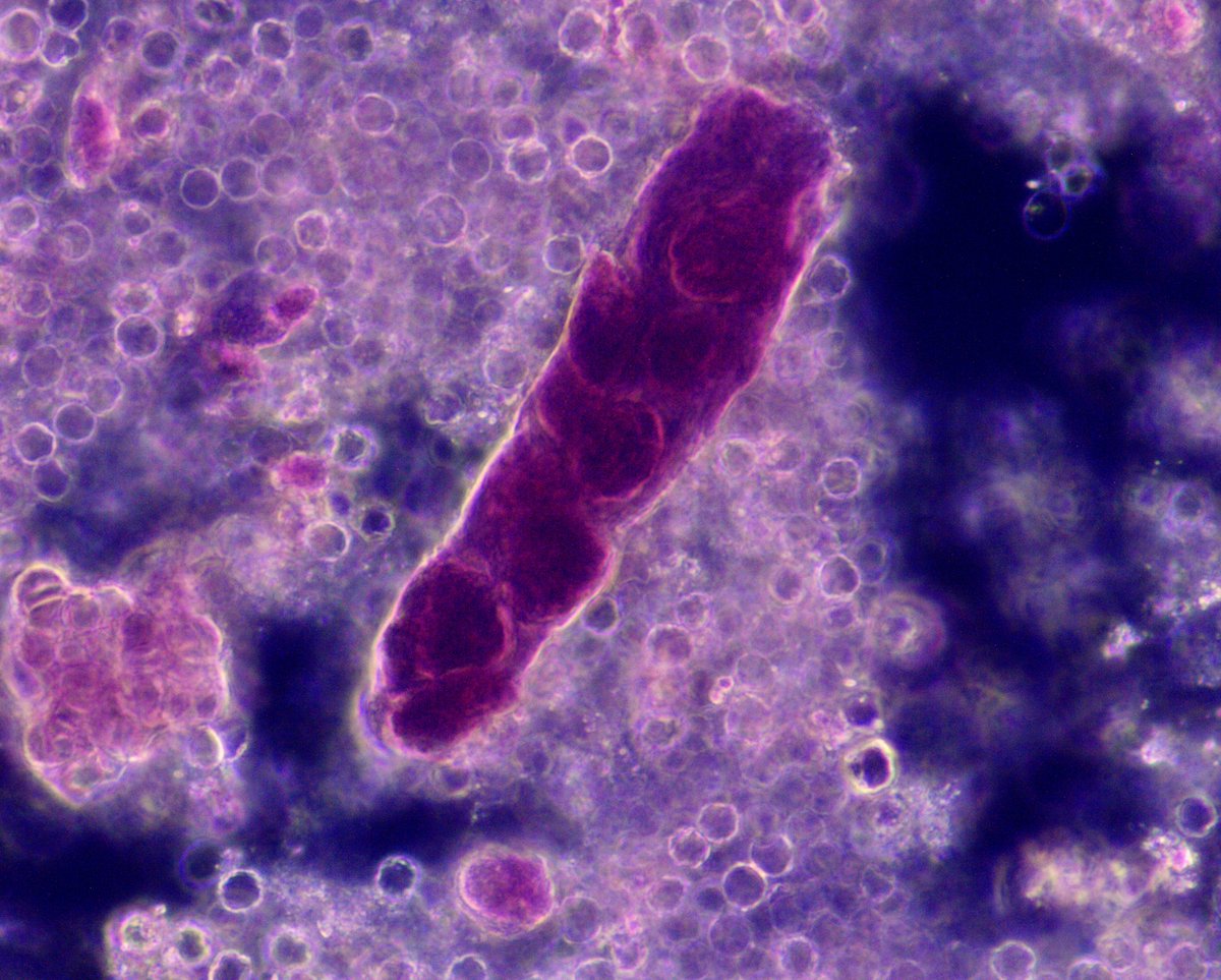 VelezNephHepato's tweet photo. Mixed (hyaline/granular) cast w/embedded CaOx monohydrate crystal, RTEC cast, isomorphic RBCs. U Na 38. AKI, ESLD, ATN, not HRS #UrinarySediment #UrineMicroscopy pt of @IMresOchsner resident @dani_nephron #WeekendCall https://t.co/ILI8AoUPgv