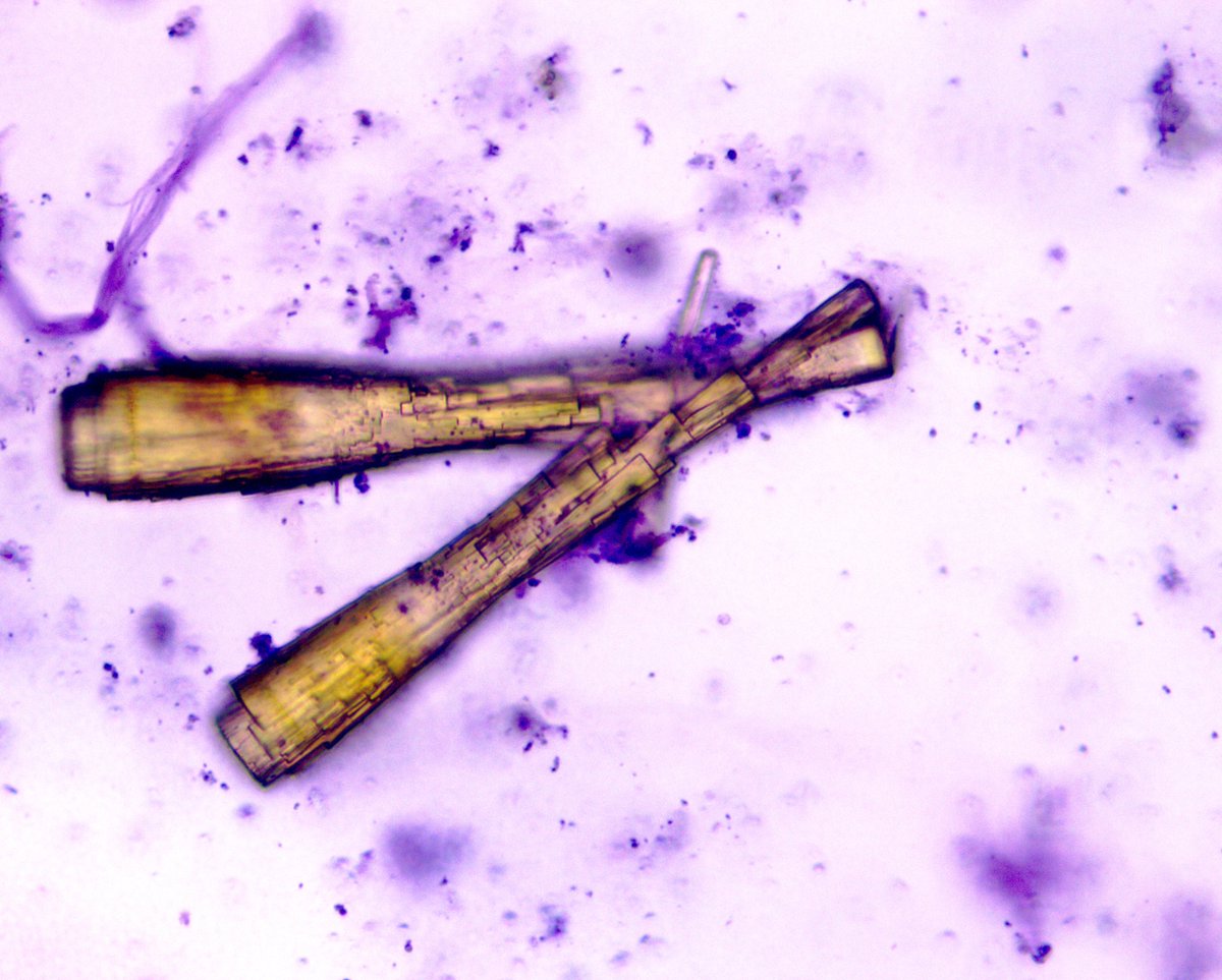 VelezNephHepato's tweet photo. Incidental finding of distinct atypical uric acid crystals (not drug crystals) mixed with dark granular casts. Sepsis, ischemic ATN. #UrinarySediment #UrineMicroscopy pt of @OchsnerNephro fellow @PJMartinezPitre #WeekendCall https://t.co/rY9kRBdIy8