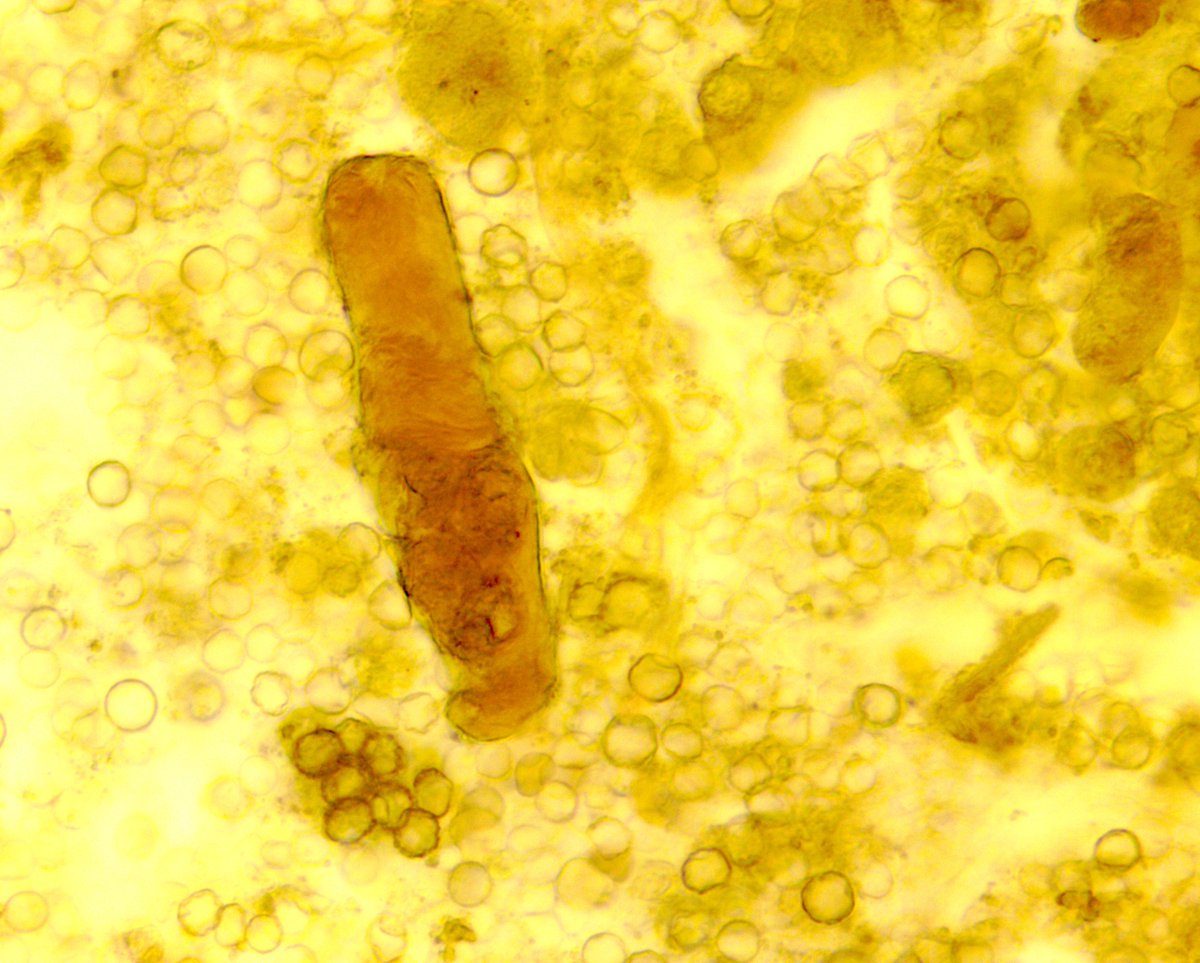 VelezNephHepato's tweet photo. Cast containing CaOx monohydrate crystals and RTECs, surrounded by isomorphic RBCs; bili-stained waxy cast #UrinarySediment #UrineMicroscopy AKI, ESLD, ATN, MAP 88, not HRS. @HrsHarmony @OchsnerNephro #WeekendCall https://t.co/3lQn4ve790