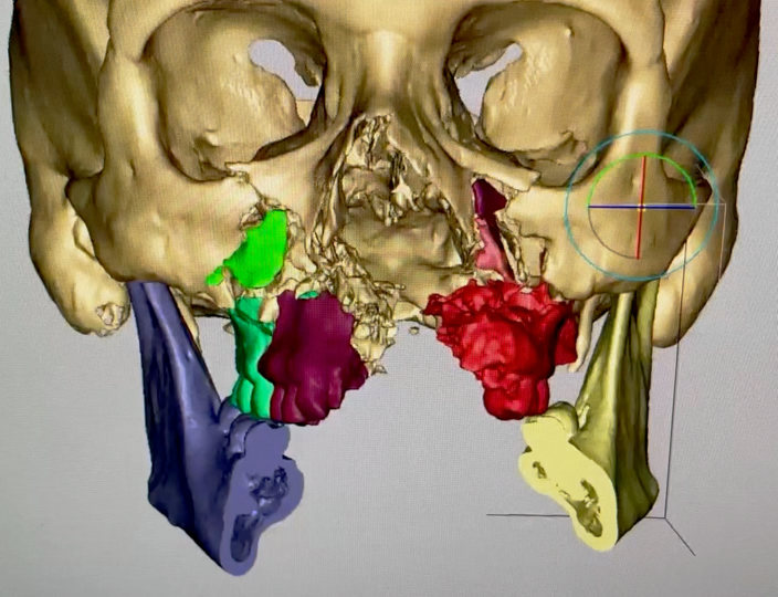 MarkKubikMD's tweet photo. Case of the week. VSP assisted reduction after facial GSW. Mandibular reconstruction with scapula due to peripheral vascular disease. This case really highlights the value of this technology. https://t.co/P37SKDJ1DA