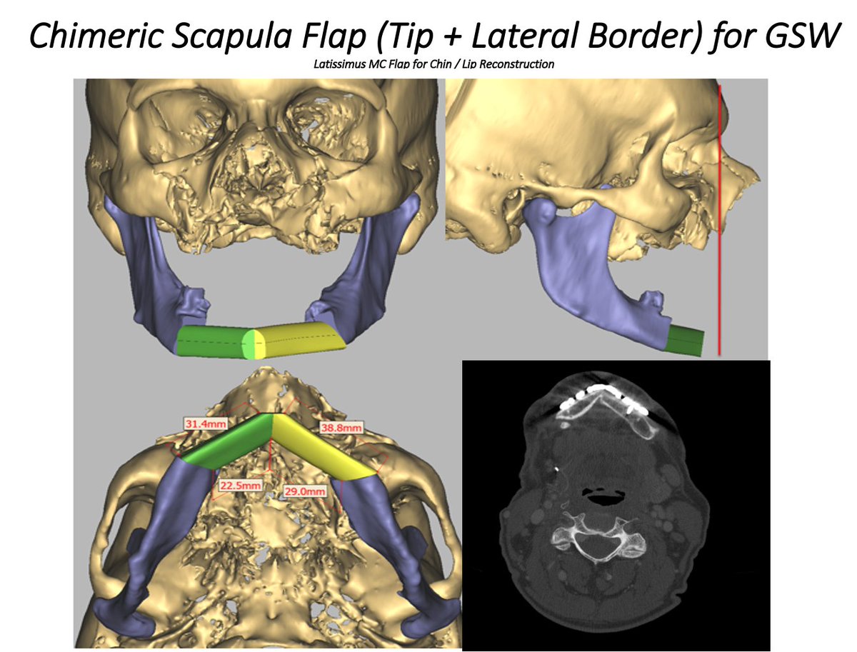 MarkKubikMD's tweet photo. Case of the week. VSP assisted reduction after facial GSW. Mandibular reconstruction with scapula due to peripheral vascular disease. This case really highlights the value of this technology. https://t.co/P37SKDJ1DA