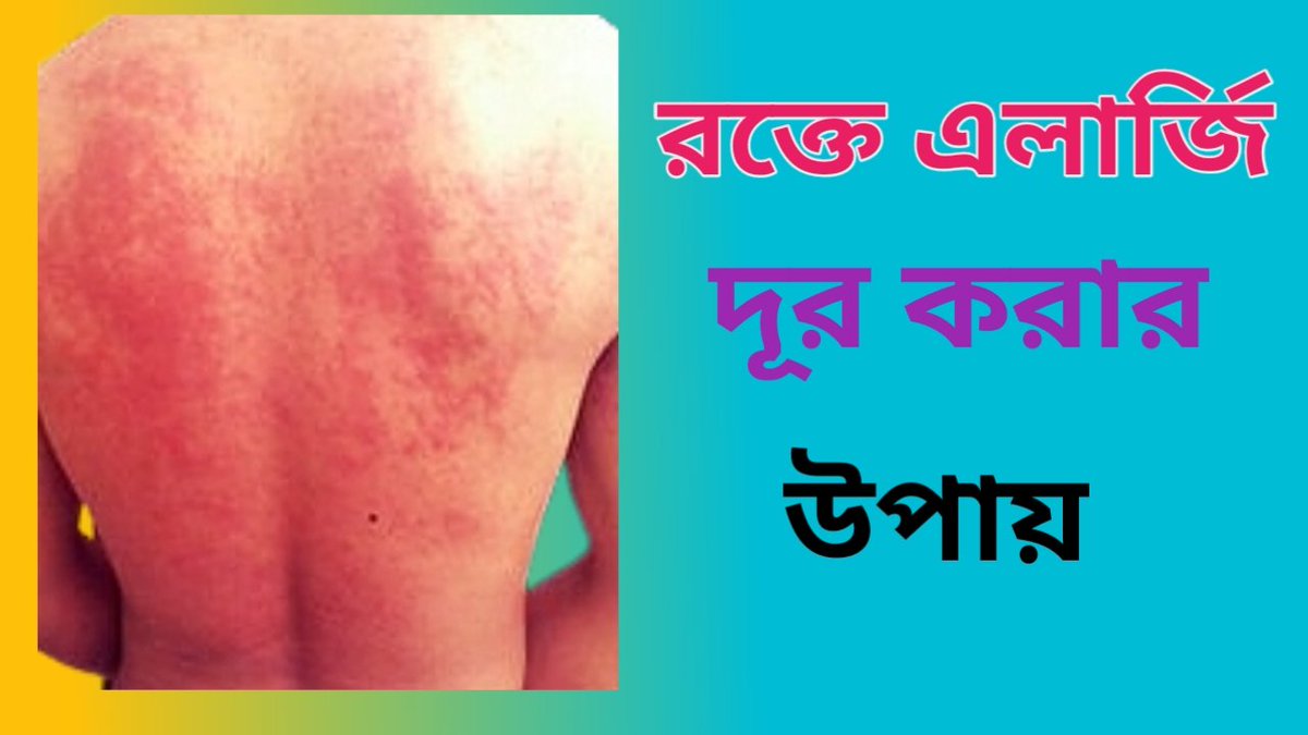 HealthSheba's tweet photo. আমাদের দেশে কমন একটা রোগ হচ্ছে এলার্জি।এই রোগ আমাদের প্রতিদিনের বিশেষ কিছু খাবার হতে বেশিরভাগ হয়ে থাকে।তাছাড়াও আশেপাশের ধুলাবালি ও ফুলের পরাগ রেণু থেকে শরীরে এলার্জি হয়ে থাকে।

পুরো পোস্টটি পড়তে ভিজিট করুনঃ  
   https://t.co/xzCHxUwSJT https://t.co/myFdDnTMaT