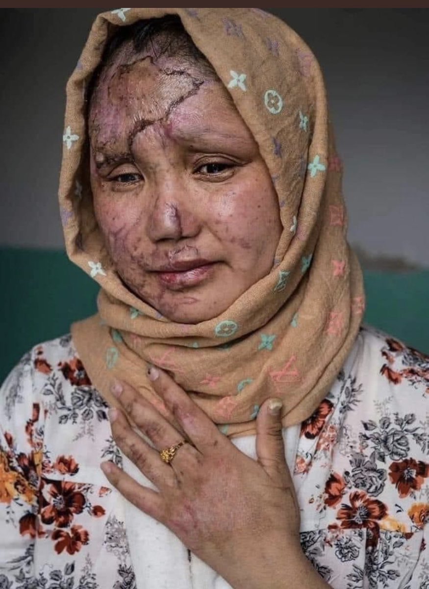 ZHazaristani's tweet photo. This is the face of Hazara  persecution. This young lady survived yesterday's bombing of an educational center in Kabul, but lost most of her friends and classmates. Her face won't make it to magazine covers in the West because she is not Malala. #StopHazaraGenocide https://t.co/vcUzgxKk37