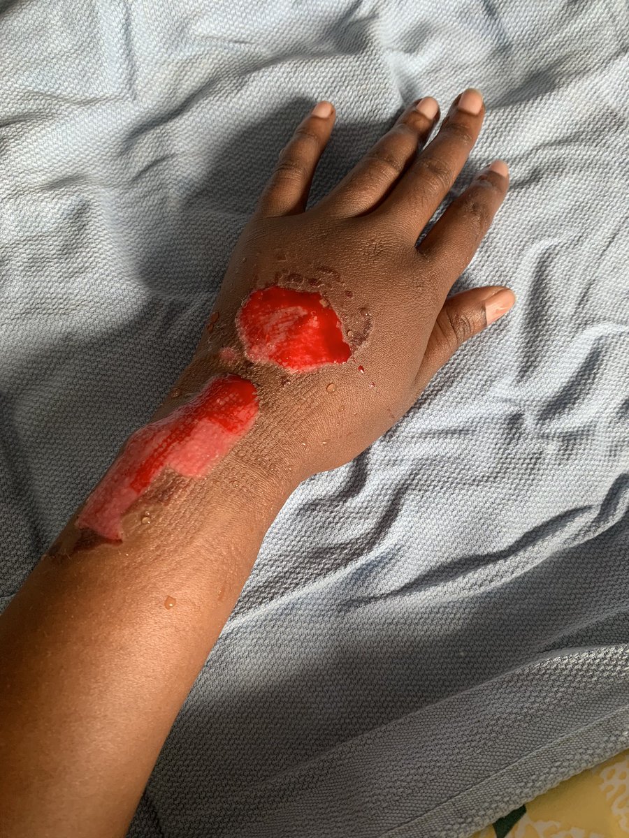 MamaRCPJ's tweet photo. Then these guys have the audacity of saying that it wasn’t Medical Negligence. Please explain how this isn’t medical negligence and ignorance since they were even confused on what to do with my swollen hand and opted for a HOT BOTTLE OF WATER?????
@DrDanielNgamije @RwandaHealth https://t.co/76FD4bzOW1