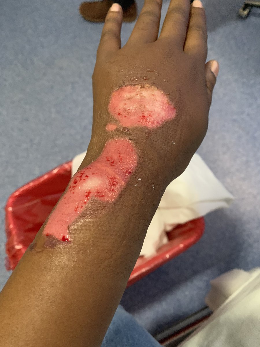 MamaRCPJ's tweet photo. Then these guys have the audacity of saying that it wasn’t Medical Negligence. Please explain how this isn’t medical negligence and ignorance since they were even confused on what to do with my swollen hand and opted for a HOT BOTTLE OF WATER?????
@DrDanielNgamije @RwandaHealth https://t.co/76FD4bzOW1