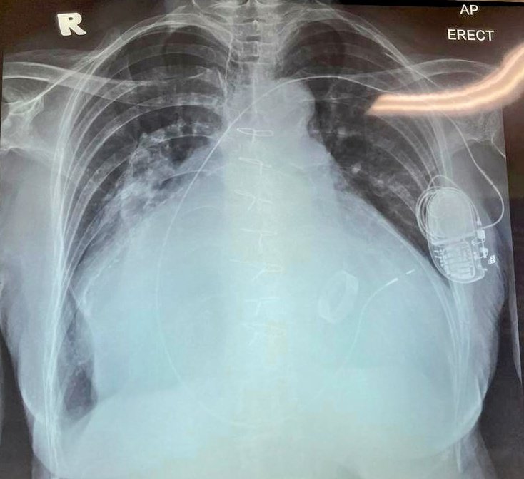 Asyiq Raffali, MD 🇲🇾 (@asyiqraffali) on Twitter photo Case from another hospital, where is the lead placed? <a href="/EPeeps_Bot/">EP_Bot</a> <a href="/ECGorEKG/">Chee Wei Shen</a> <a href="/narrowQRS/">JMC</a> <a href="/Hapa_EP/">Kevin Brady</a> <a href="/HakimIcu/">Hakim Noman ,MD,PHD,FHRS,FSCAI</a> <a href="/EpRaqib/">A Raqib A Ghani</a> Case from another hospital, where is the lead placed? <a href="/EPeeps_Bot/">EP_Bot</a> <a href="/ECGorEKG/">Chee Wei Shen</a> <a href="/narrowQRS/">JMC</a> <a href="/Hapa_EP/">Kevin Brady</a> <a href="/HakimIcu/">Hakim Noman ,MD,PHD,FHRS,FSCAI</a> <a href="/EpRaqib/">A Raqib A Ghani</a>