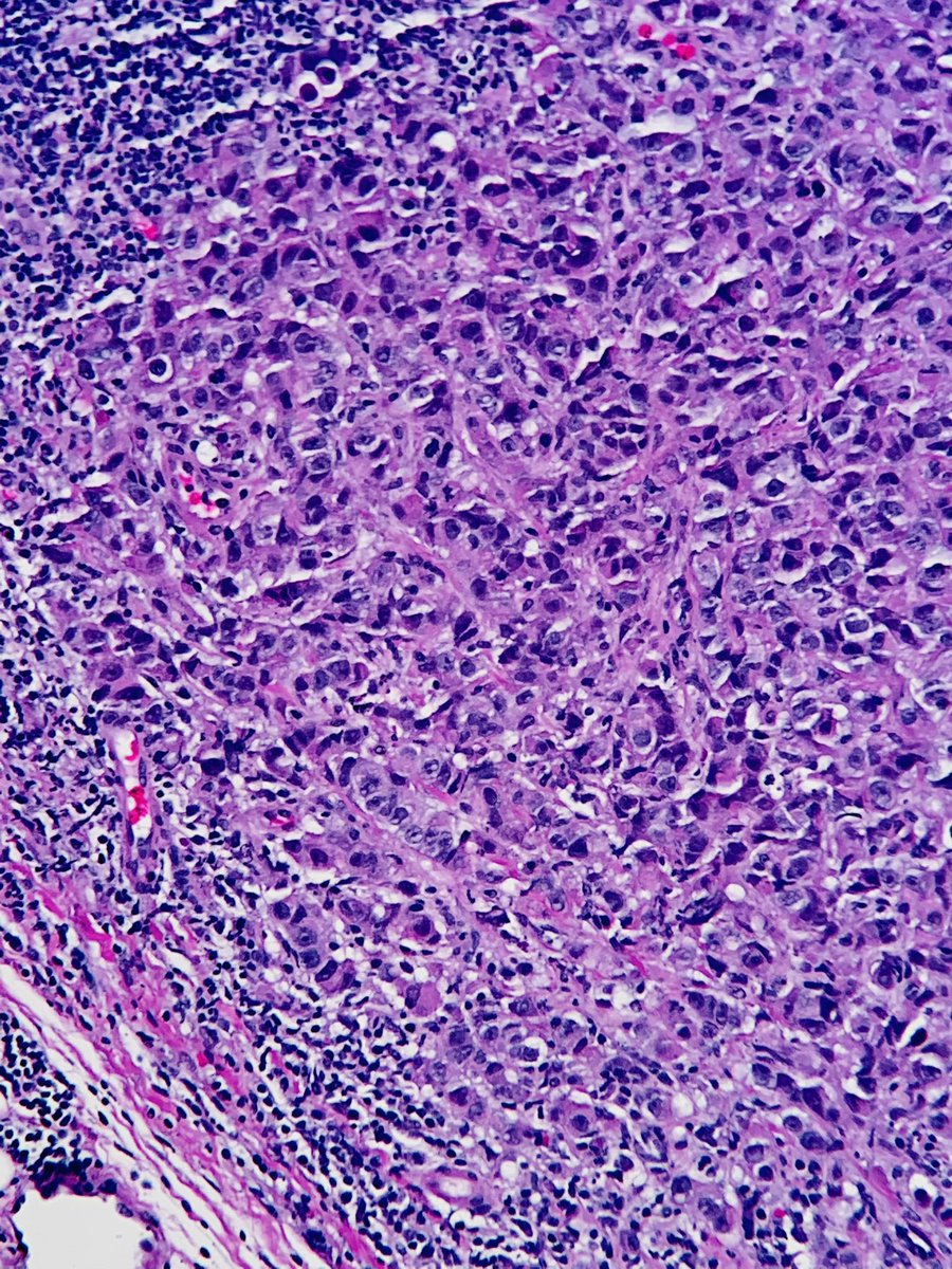Axillary lymph node- core needle biopsy 💉
Metastatic carcinoma -history of Breast carcinoma #breastpath #everydaybreast #pathology #PathResident #pathfellow