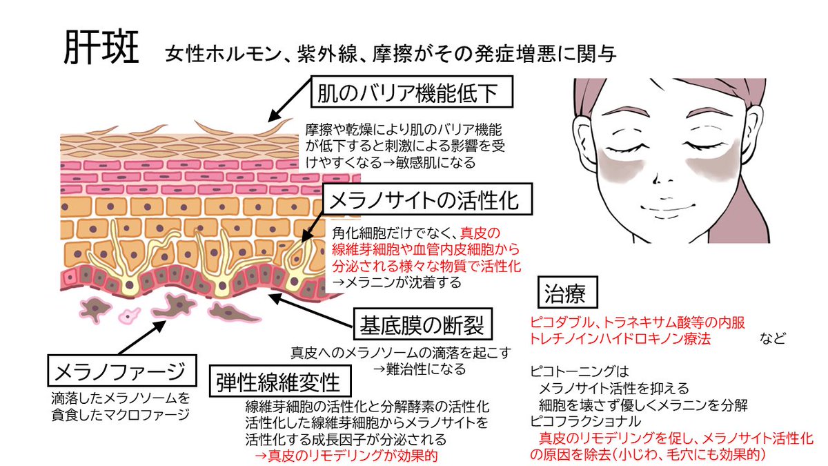 dr_ishiikanto's tweet photo. シミ治療について
シミの種類としては老人性色素斑、肝斑、ADM、炎症後色素沈着が大きく分けられます。
原因と治療方法について当院で扱っている施術含めてまとめさせていただきました。 https://t.co/HKemDqy4cU