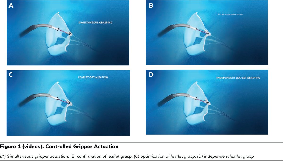 #TEER ebook highlight—Chapter 13: Use of Controlled Gripper Actuation This chapter describes appropriate application of 4 controlled gripper actuation maneuvers and reviews potential pitfalls and possible complications ➡️ scaipro.scai.org/URL/TEEReBookT… @matthewjpricemd @AbbottCardio