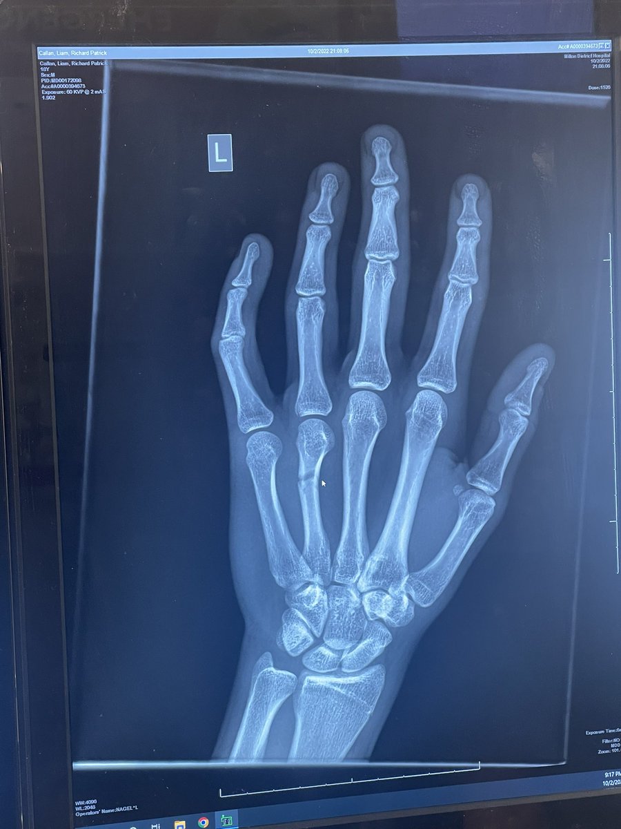 IAmLeroyyy's tweet photo. I broke my hand last night blocking a shot during my hockey game. Cant use my left hand for at least 2 weeks until I can see a plastic surgeon for a follow up. Meaning I can hardly play any sort of video games. This is not what i needed 😂 https://t.co/DXybN4Oi44