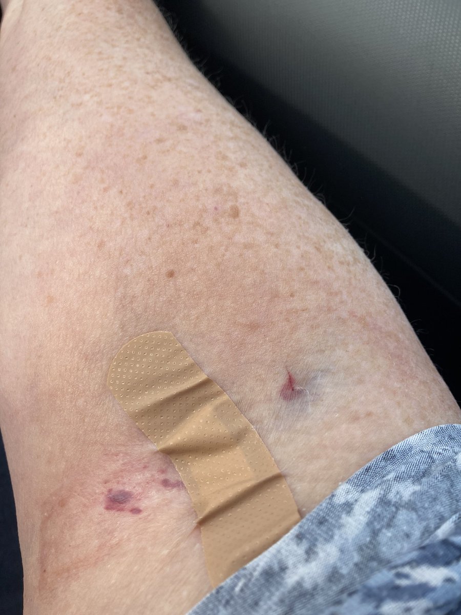 I always say “I’m not good with micropore/ or hypoallergenic dressings”. Rarely listened to. Today at least when I got to phlebotomy, after two failed attempt in pre-op, they could see what I meant!