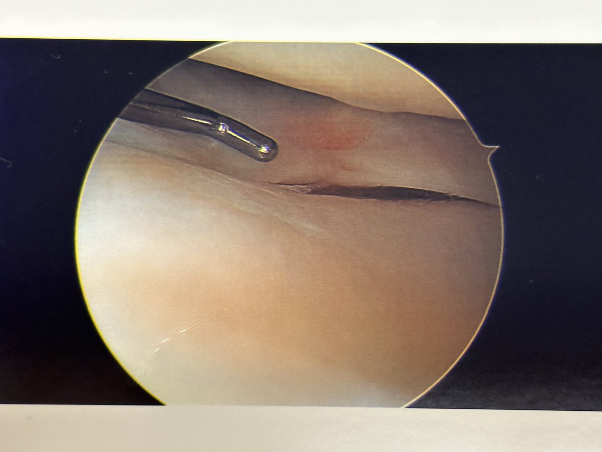 #MeniscusMonday deep radial posterior horn lateral meniscus tear seen at MUA, found had healed when we went back in #orthotwitter