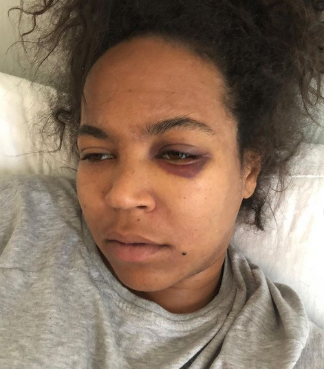 lipstickalley's tweet photo. ASHANTIโs sister reposts her abuse pics by #SLOWBUCKS for Domestic Violence survivors month https://t.co/B9U64Bvuie https://t.co/UaS3ol7KLH