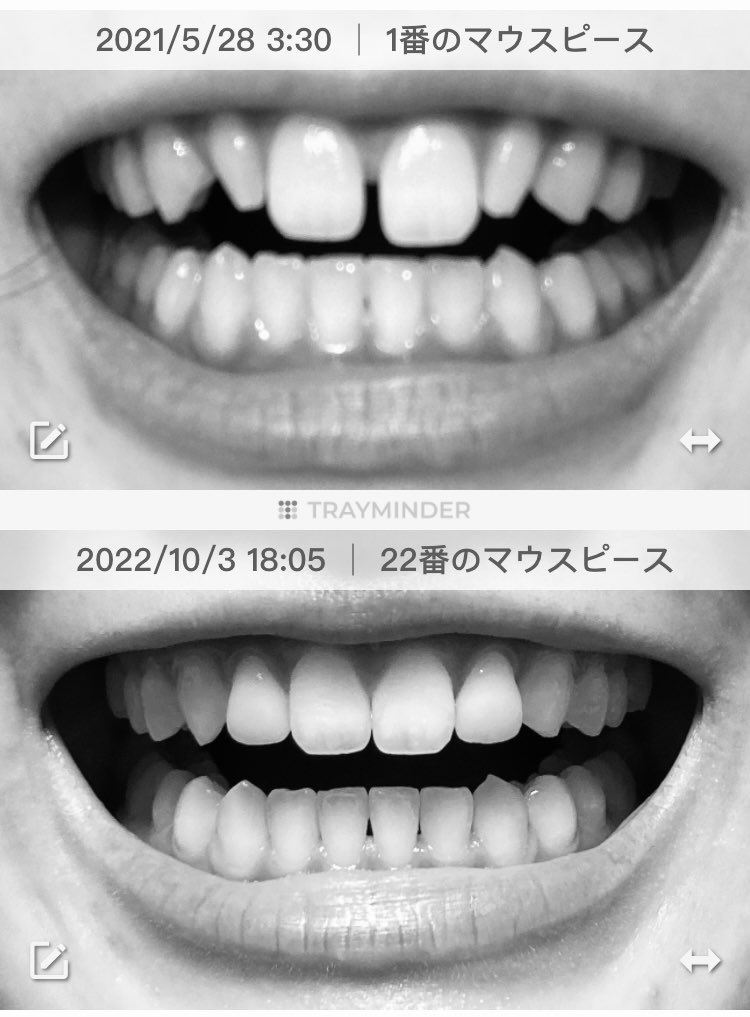 kyouseiMin's tweet photo. 実は8月頭ぐらいに一応矯正終わってて、そこからちょっと色々微調整があって、9月頭に完全に終わっておりました🦷リテーナー生活です🦷
すきっ歯解消されたし矮小歯2本にセラミックかぶせたし、まあおおむね満足！
やっぱり自分が映ってる笑顔の写真とか見ると、矯正前と全然違って綺麗で、嬉しいね✌️ https://t.co/3gOMWiAfAH
