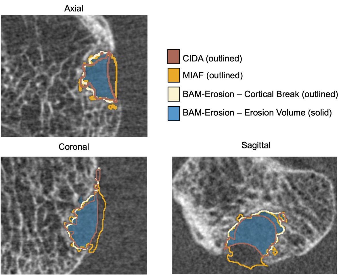 Excited that our paper demonstrating our new, open-source, erosion analysis tool (Bone Analysis Modules – Erosion) is published in Bone! doi.org/10.1016/j.bone…. We compared the results to existing tools CIDA &amp; MIAF. Code available for download! github.com/ManskeLab/Bone…