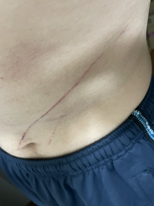 暗闇の中ドブに落っこちて怪我した中年小太り男性 