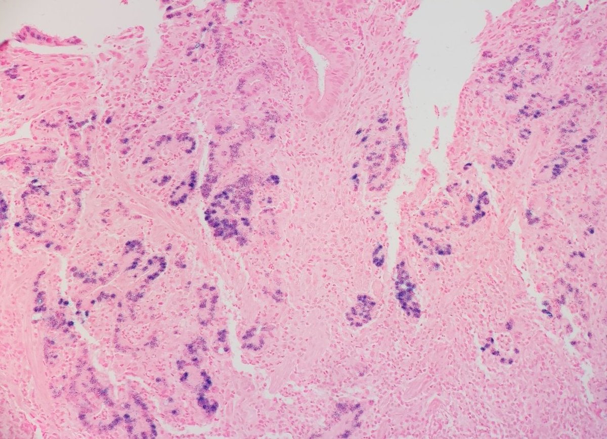 Gastric adenocarcinoma with lymphoid stroma, EBV-associated.

#GIpath #pathology #PathTwitter #PathMatch2023 #MedTwitter