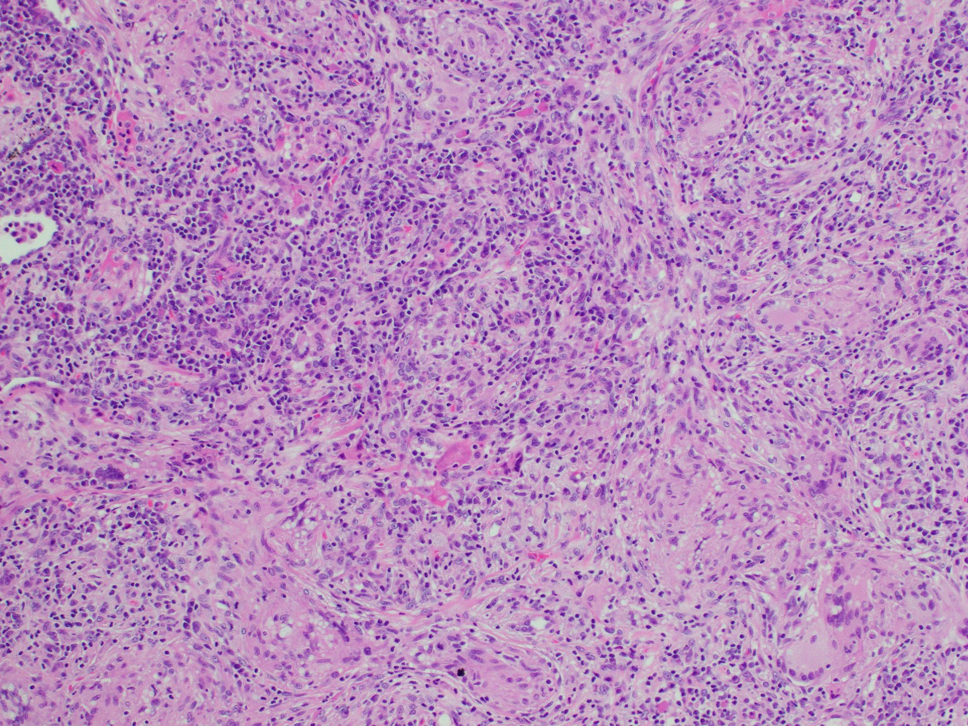Albany Med Pathology On Twitter Happy Monday Here Is A Lung Lesion albany-med-pathology-on-twitter-happy-monday-here-is-a-lung-lesion