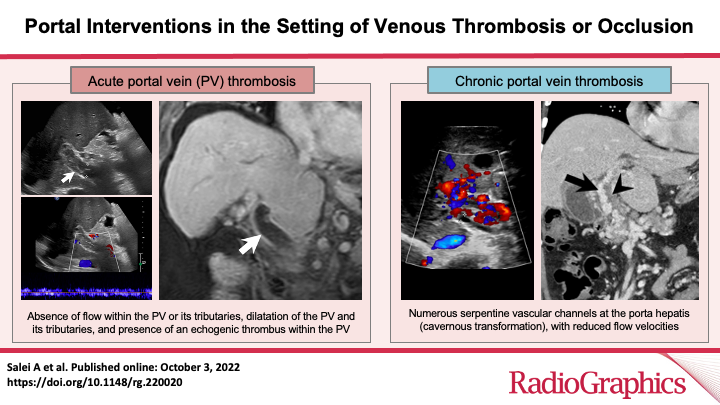 RadioGraphics_Editor (@radg_editor) on Twitter photo Portal Interventions in the Setting of Venous Thrombosis or Occlusion
Salei A et al
Liver & Pancreatic Interventions
doi.org/10.1148/rg.220…
<a href="/rakeshkvarma/">Rakesh Varma</a>
<a href="/uab_ir/">UAB IR</a>
<a href="/UABRadiology/">UAB Radiology</a>
#RGphx
8/20 Portal Interventions in the Setting of Venous Thrombosis or Occlusion
Salei A et al
Liver & Pancreatic Interventions
doi.org/10.1148/rg.220…
<a href="/rakeshkvarma/">Rakesh Varma</a>
<a href="/uab_ir/">UAB IR</a>
<a href="/UABRadiology/">UAB Radiology</a>
#RGphx
8/20
