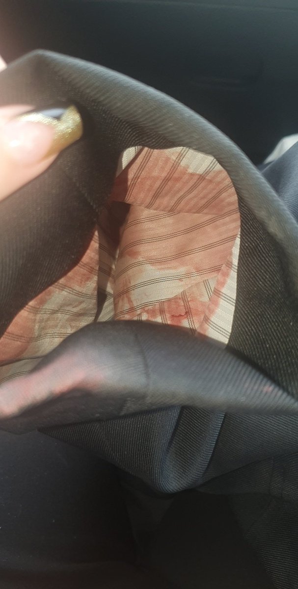proshtwt's tweet photo. Got steri strip and need stitches. I took the steri strips off and I'm so tired,another camhs meeting for nothing https://t.co/5e8DHNkcn8