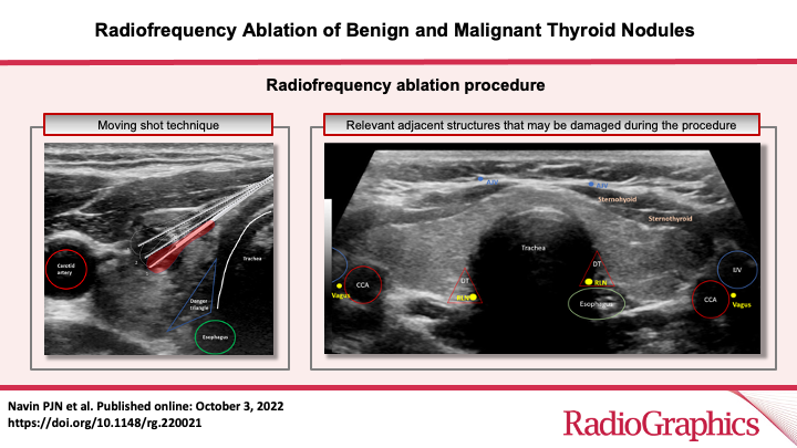 Radiofrequency Ablation of Benign &amp; Malignant Thyroid Nodules 
Navin PJN et al
New Tools &amp; Procedures
doi.org/10.1148/rg.220… 

@patrickjnavin
<a href="/ANKurupMD/">Anil Nicholas Kurup</a>
<a href="/MayoRadiology/">Mayo Clinic Radiology</a>
<a href="/MayoClinicEndo/">Mayo Clinic Endocrinology</a> 
<a href="/Welch_IO/">Brian Welch</a>
<a href="/mrcastro123/">M. Regina Castro</a>
<a href="/mattcallstrom/">Matt Callstrom MD</a>
#RGphx
15/20