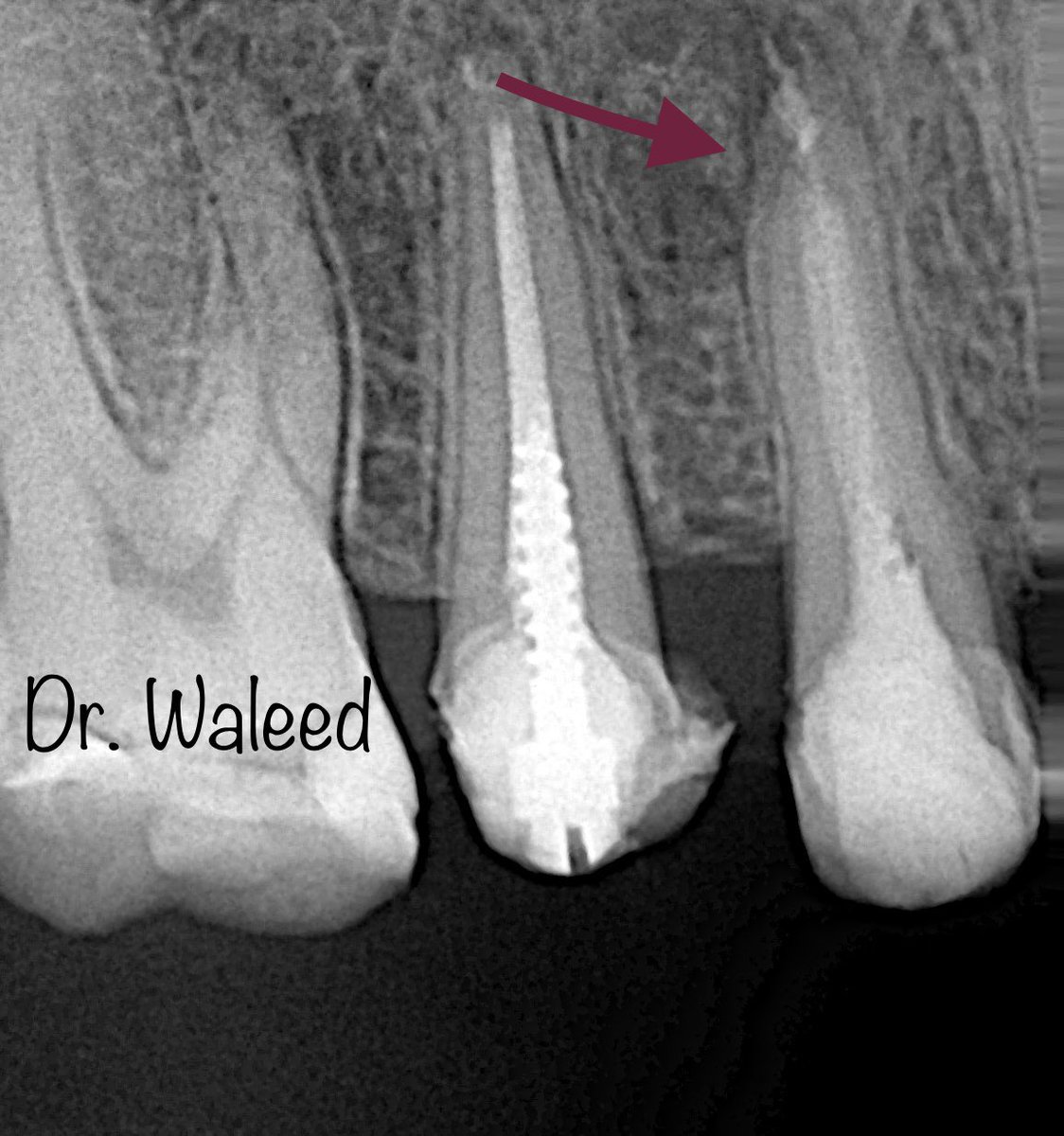 endodontist_w's tweet photo. هاليومين كان عندنا حالة بالعيادة لمبرد مكسور داخل السن 👇🏼 
📍 الأداة او المبرد المكسور كان في الجزء السفلي من الجذر

بتسهيل رب العالمين ومن ثم استخدام (المجهر) أثناء علاج العصب قدرنا  نحدد مكان المبرد ونسحبه خارج السن ونعقم بشكل جيد https://t.co/rVda9DCnJo
