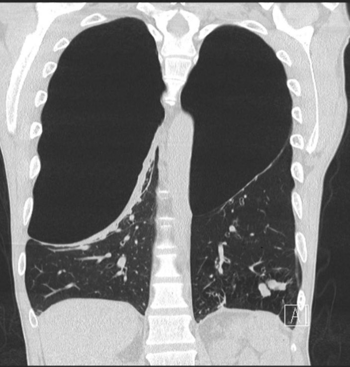 This patient was in acute hypoxemic respiratory failure. Do they need chest tubes?

#MedTwitter