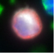 DefineMBC's tweet photo. For the DefineMBC team, pink isn’t just a focus in October. We see pink year-round with our proprietary immunofluorescence technology that detects circulating tumor cells. Discover our innovative liquid biopsy for patients with metastatic breast cancer with DefineMBC. https://t.co/EPwRXdu8RM