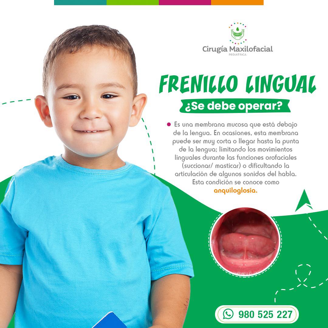 🔸La #Cirugía_de_Frenillo_Lingual_Corto ✅ Cirujano Maxilofacial Pediatrico ✅wa.me/51980525227 📲 980 525 227 #Frenillos #Bebé #Niños #Bebé #Niños #Frenillolingual #Cirugíamaxilofacialodontopediatria #cirugía #niñosfelicespadresfelices #sonriesiempre #niñosyniñasfelices