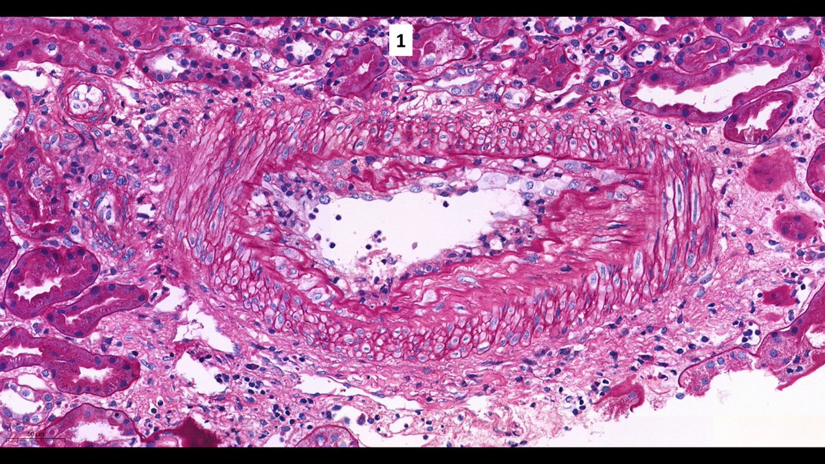 roboonya's tweet photo. Acute antibody-mediated rejection in a young pt. with living-related tx 1 wk posttx. 1 intimal arteritis 2 glomerulitis 3 peritubular capillaritis #renalpath #transplantpath https://t.co/f4QwnraMTJ